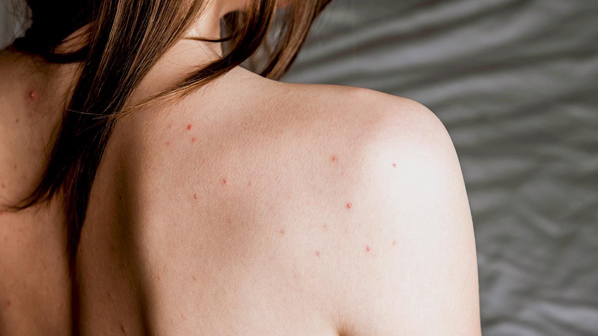 Rygg på kvinna med akne